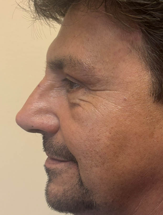 After Image: Patient Case #18625 - left-side