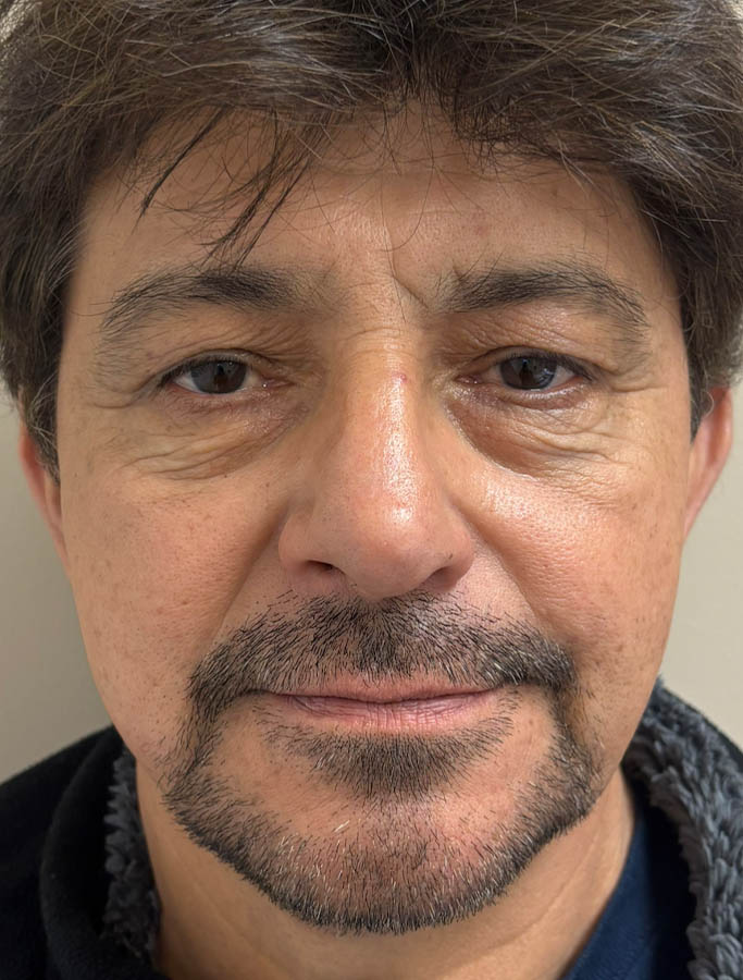 Before Image: Patient Case #18625 - front