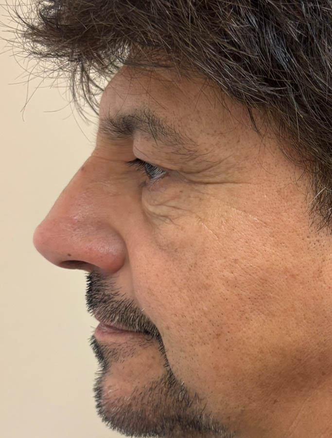 Before Image: Patient Case #18625 - left-side