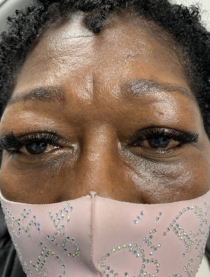 Before Image: Patient Case #1868 - front