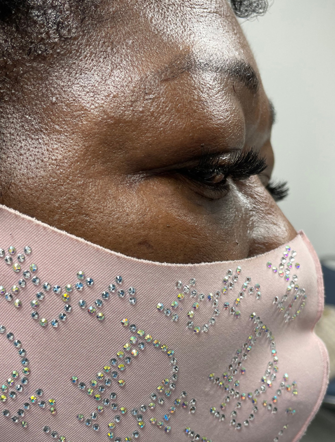 Before Image: Patient Case #1868 - right-side