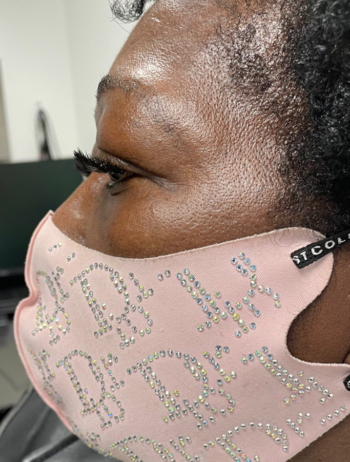 Before Image: Patient Case #1868 - left-side