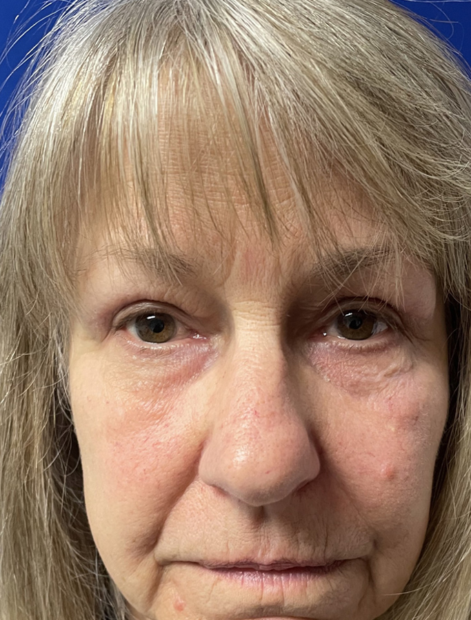 After Image: Patient Case #1875 - front