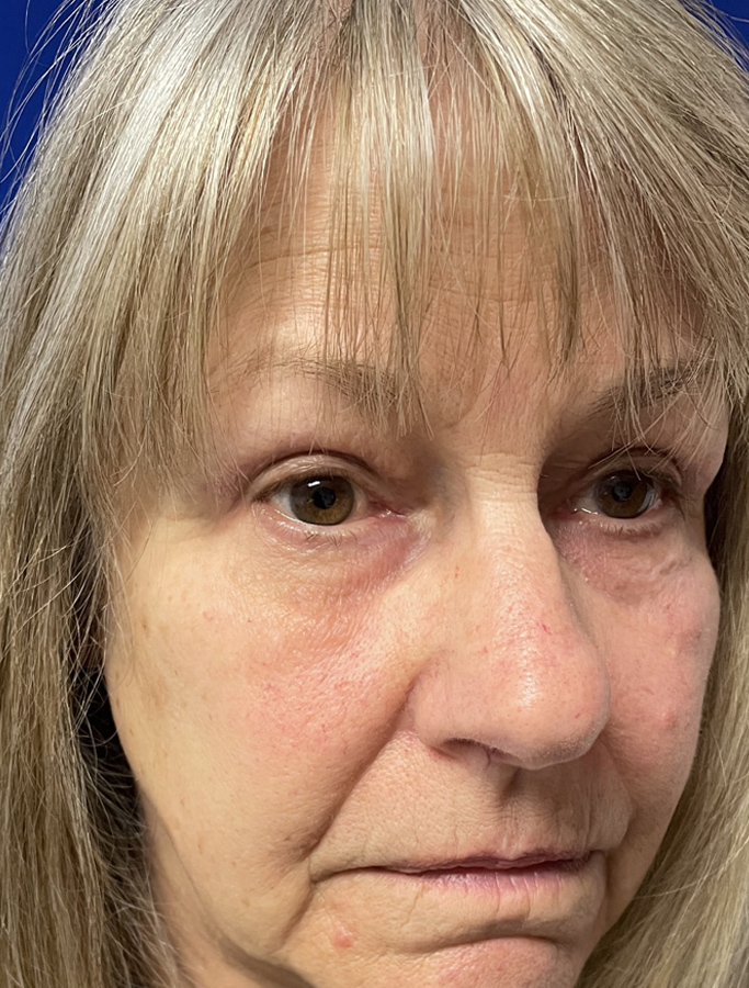 After Image: Patient Case #1875 - right-front-oblique