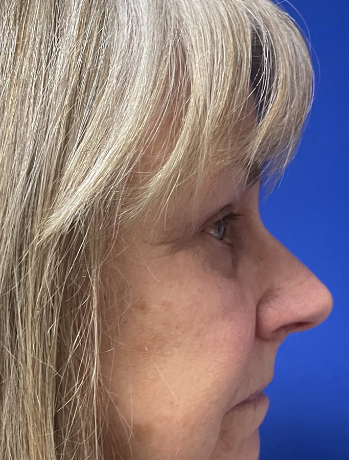 After Image: Patient Case #1875 - right-side