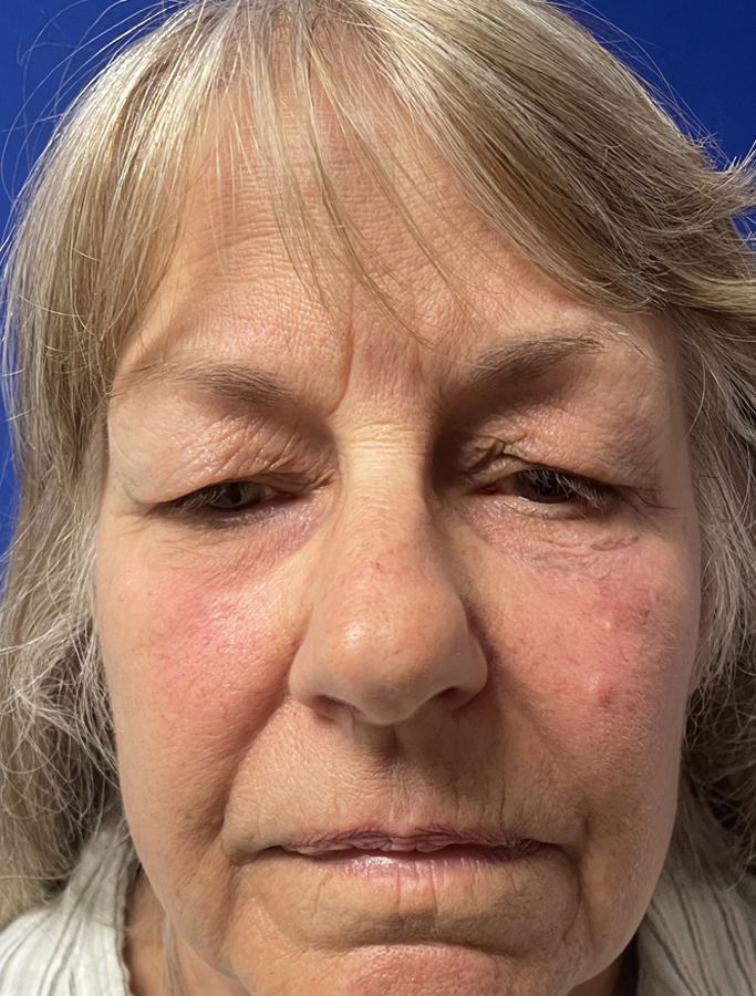 Before Image: Patient Case #1875 - front