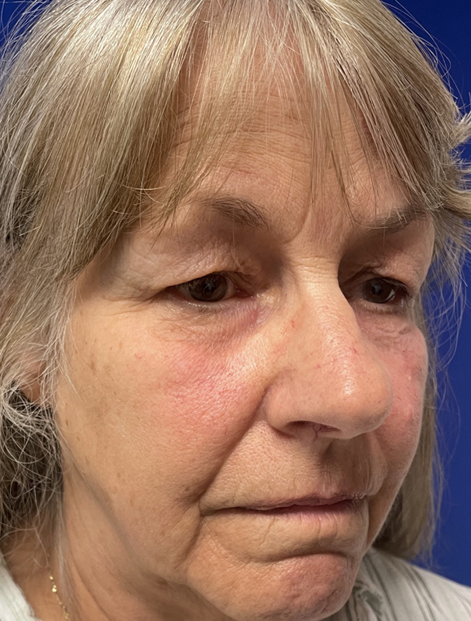 Before Image: Patient Case #1875 - right-front-oblique