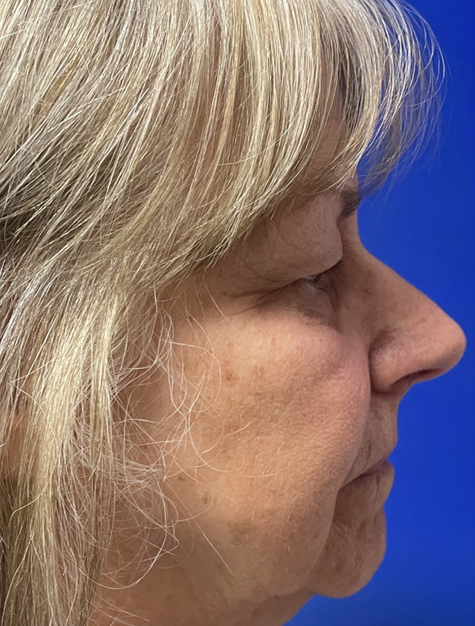 Before Image: Patient Case #1875 - right-side