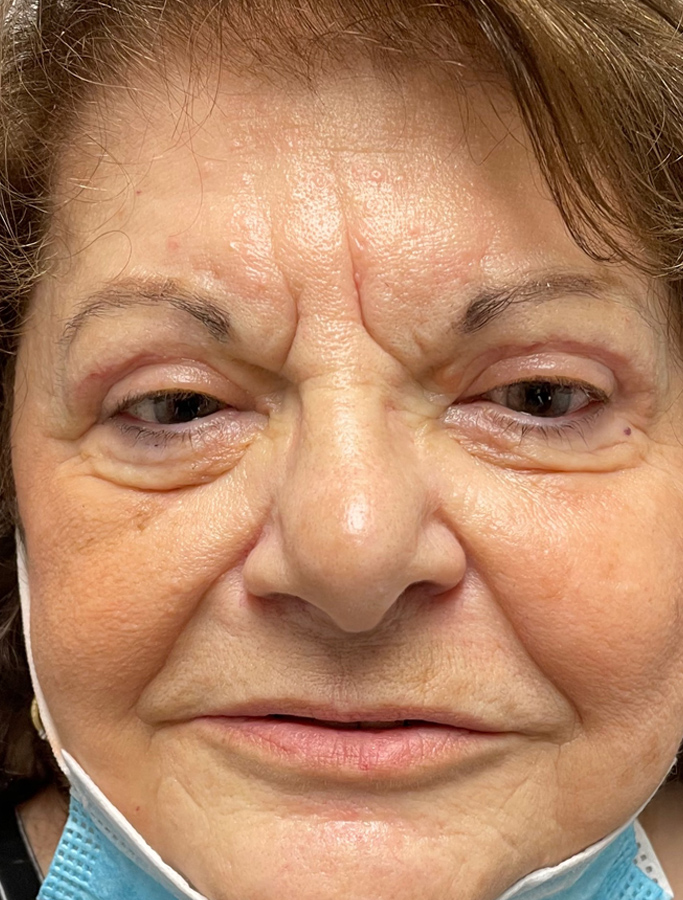 After Image: Patient Case #1886 - front