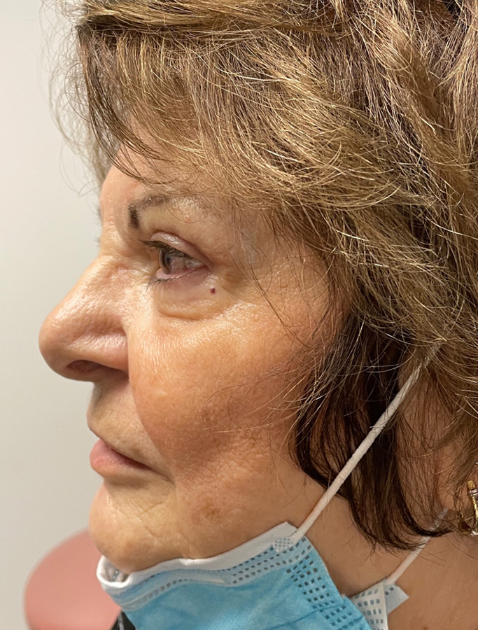 After Image: Patient Case #1886 - left-side