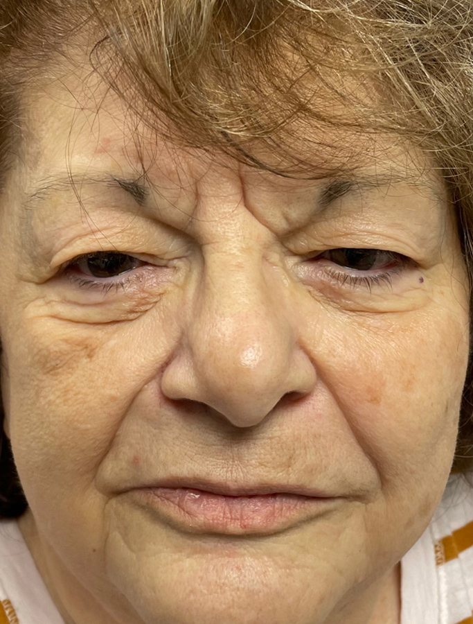 Before Image: Patient Case #1886 - front