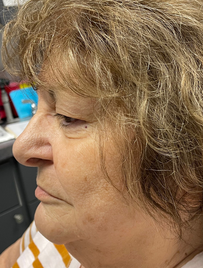 Before Image: Patient Case #1886 - left-side