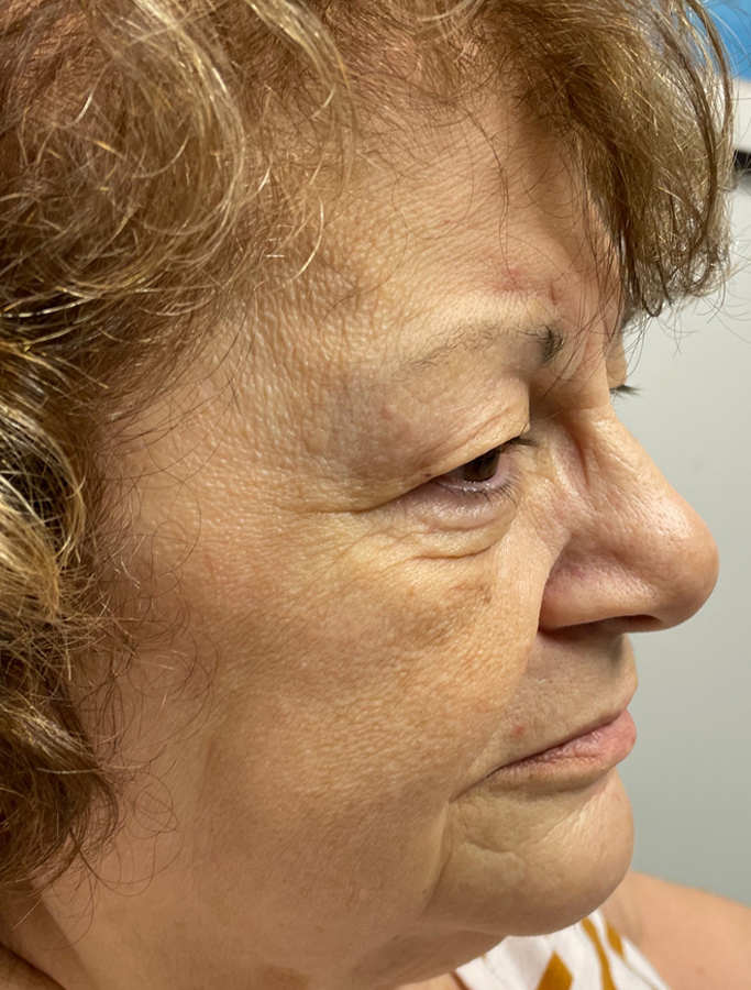 Before Image: Patient Case #1886 - right-side