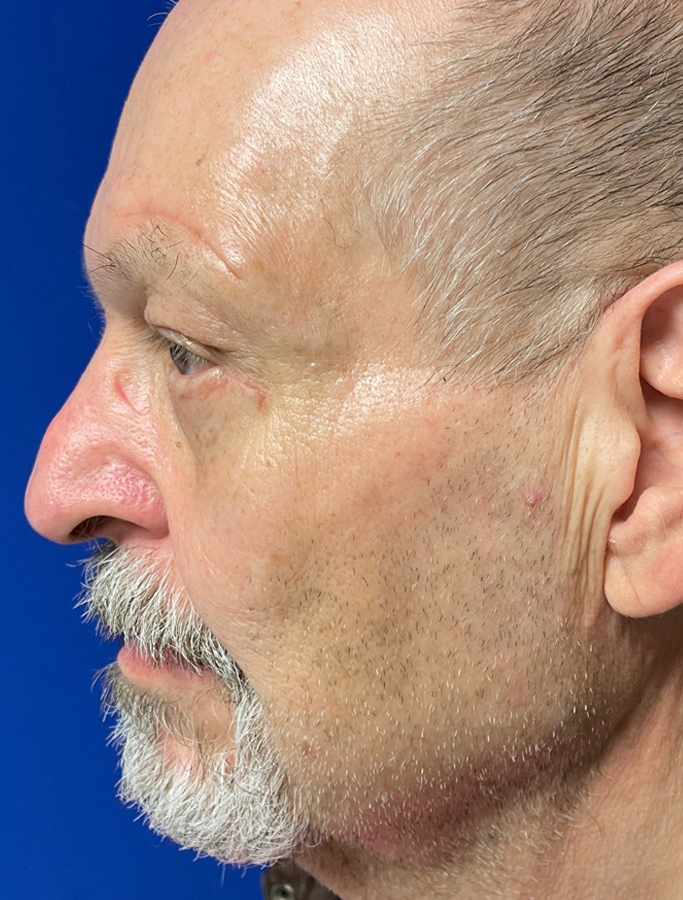 After Image: Patient Case #1894 - left-side