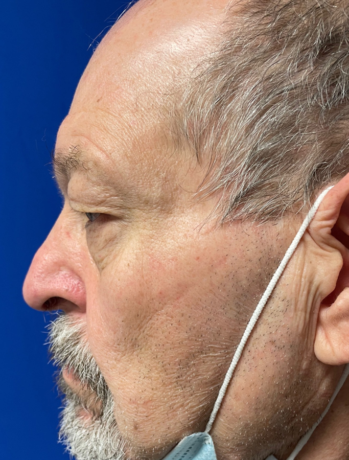 Before Image: Patient Case #1894 - left-side