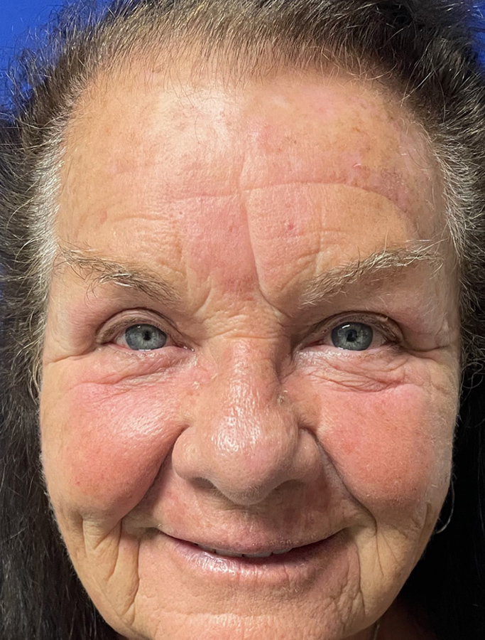 After Image: Patient Case #1907 - front