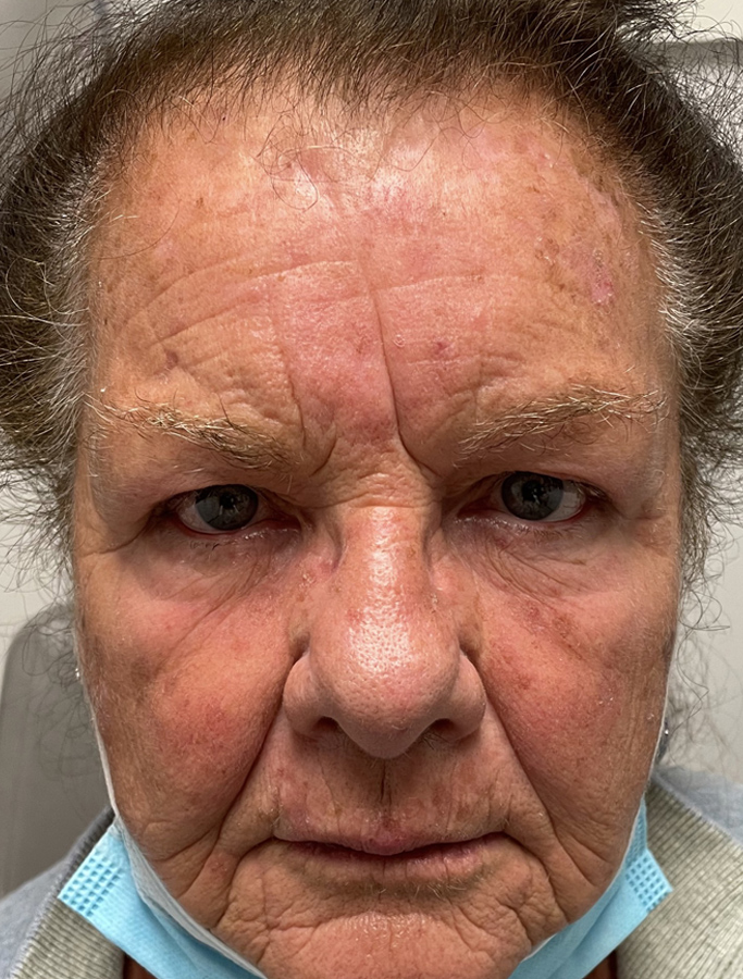 Before Image: Patient Case #1907 - front