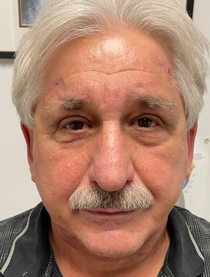 After Image: Patient Case #1910 - front