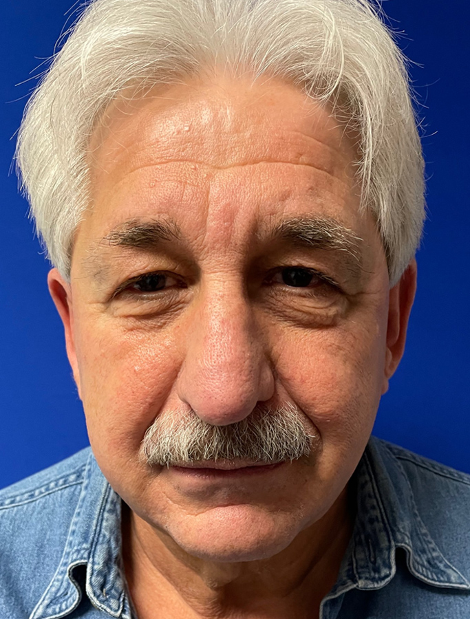 Before Image: Patient Case #1910 - front