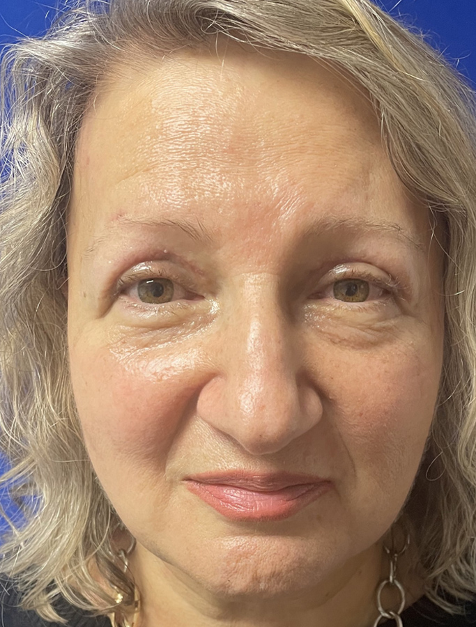 After Image: Patient Case #1913 - front