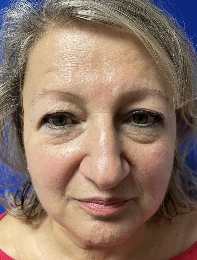 Before Image: Patient Case #1913 - front