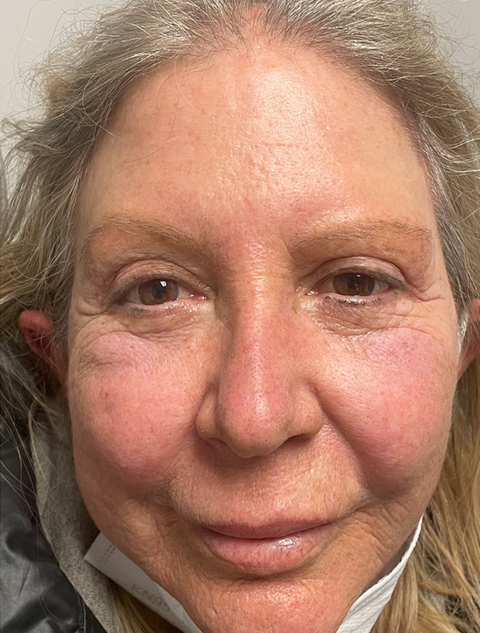 After Image: Patient Case #1916 - front