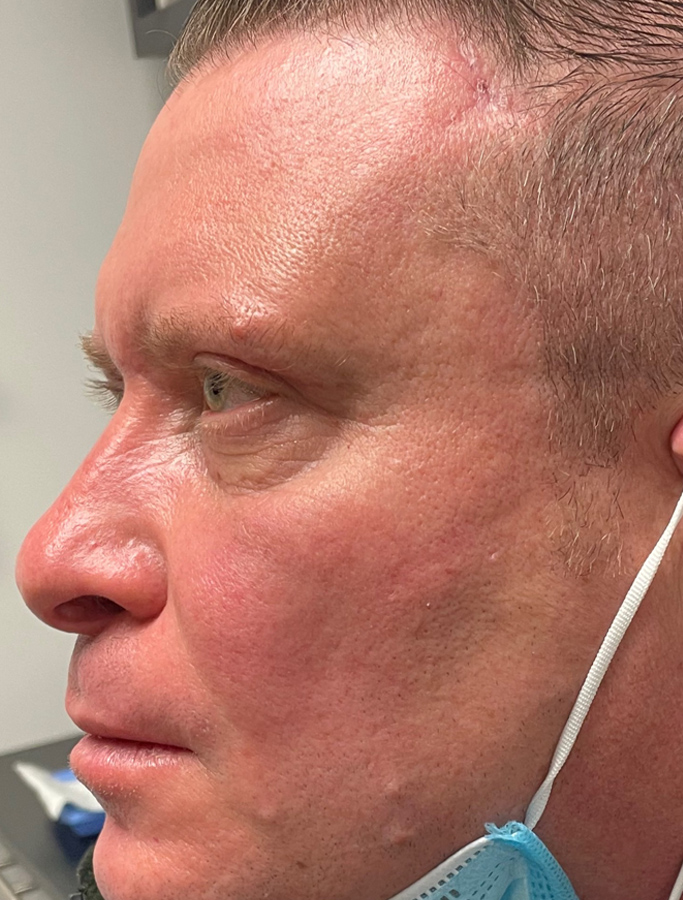 After Image: Patient Case #1919 - left-side