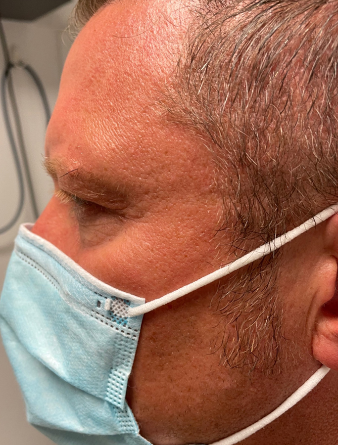 Before Image: Patient Case #1919 - left-side