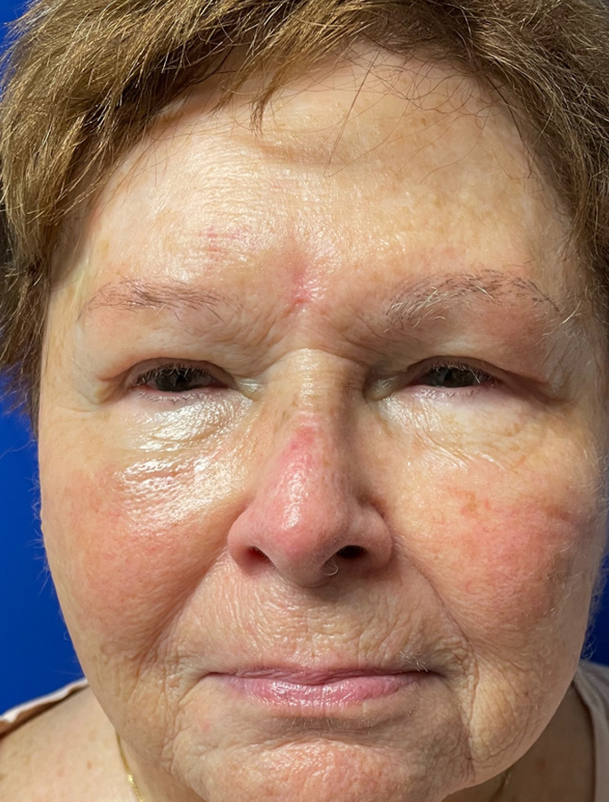 After Image: Patient Case #1930 - front