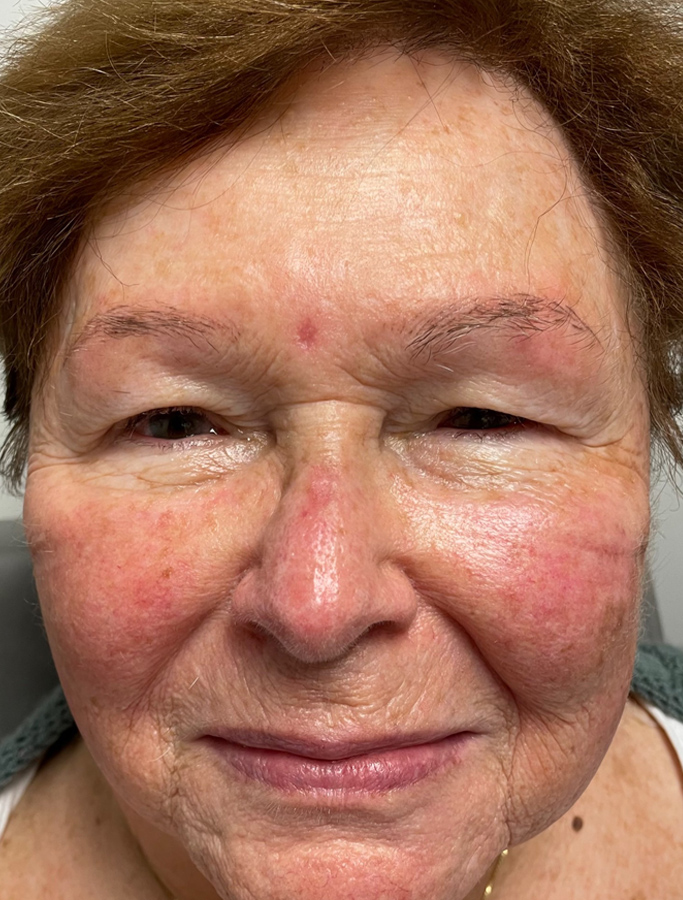 Before Image: Patient Case #1930 - front