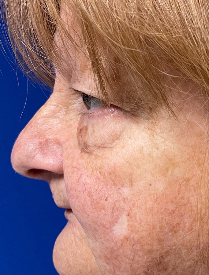 Before Image: Patient Case #1938 - left-side