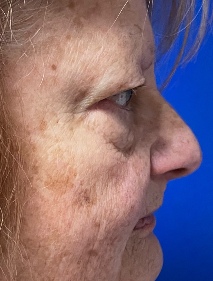 Before Image: Patient Case #1938 - right-side