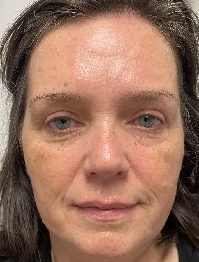 After Image: Patient Case #1943 - front