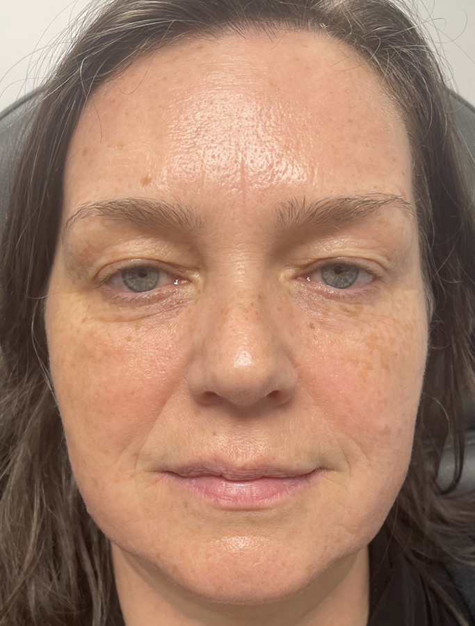 Before Image: Patient Case #1943 - front