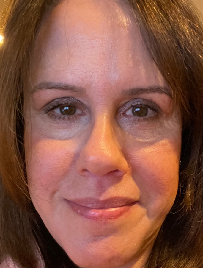 After Image: Patient Case #1946 - front