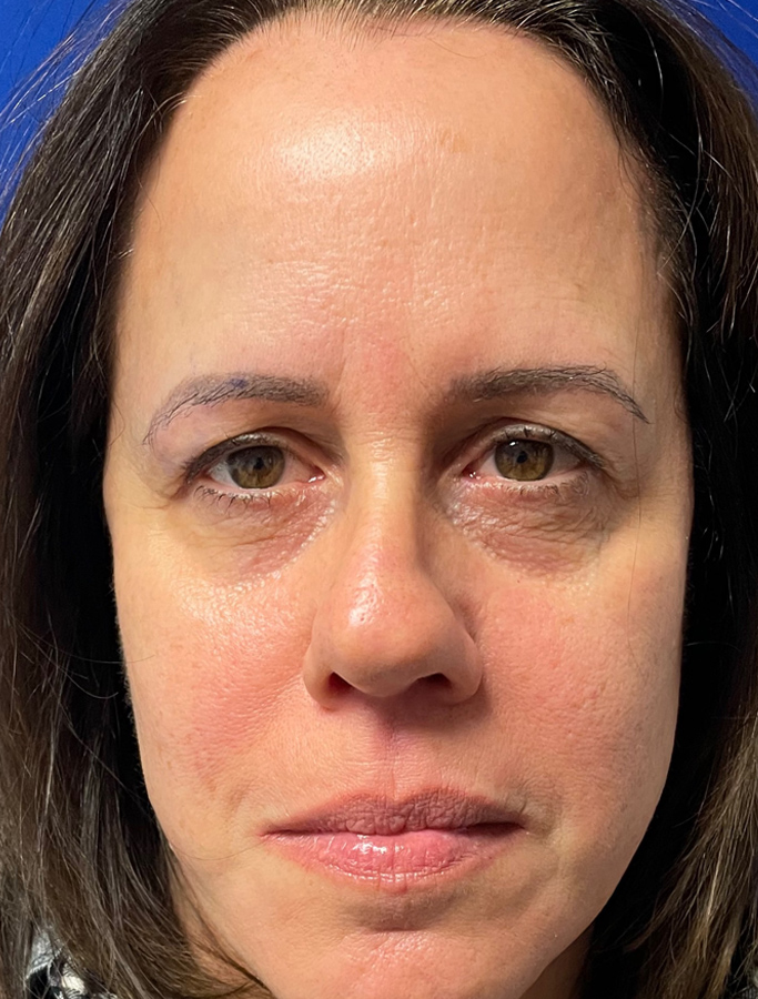 Before Image: Patient Case #1946 - front