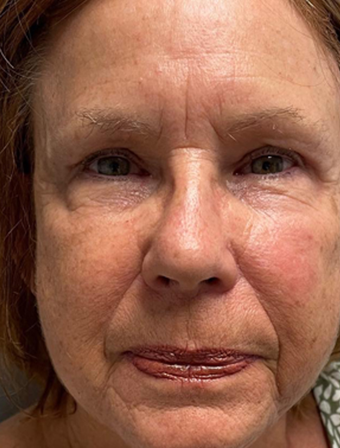 After Image: Patient Case #1949 - front