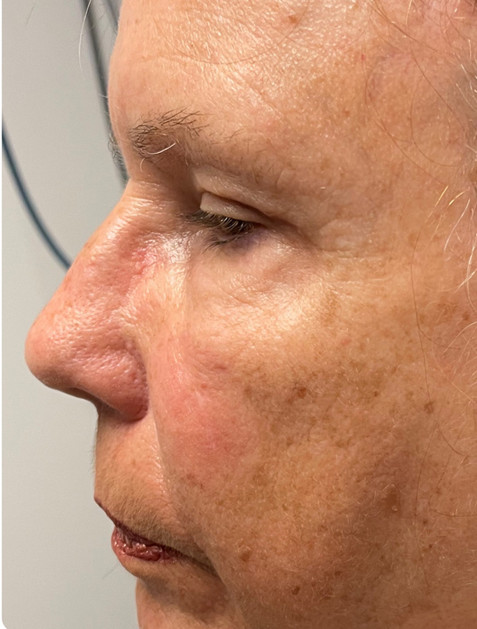 After Image: Patient Case #1949 - left-side