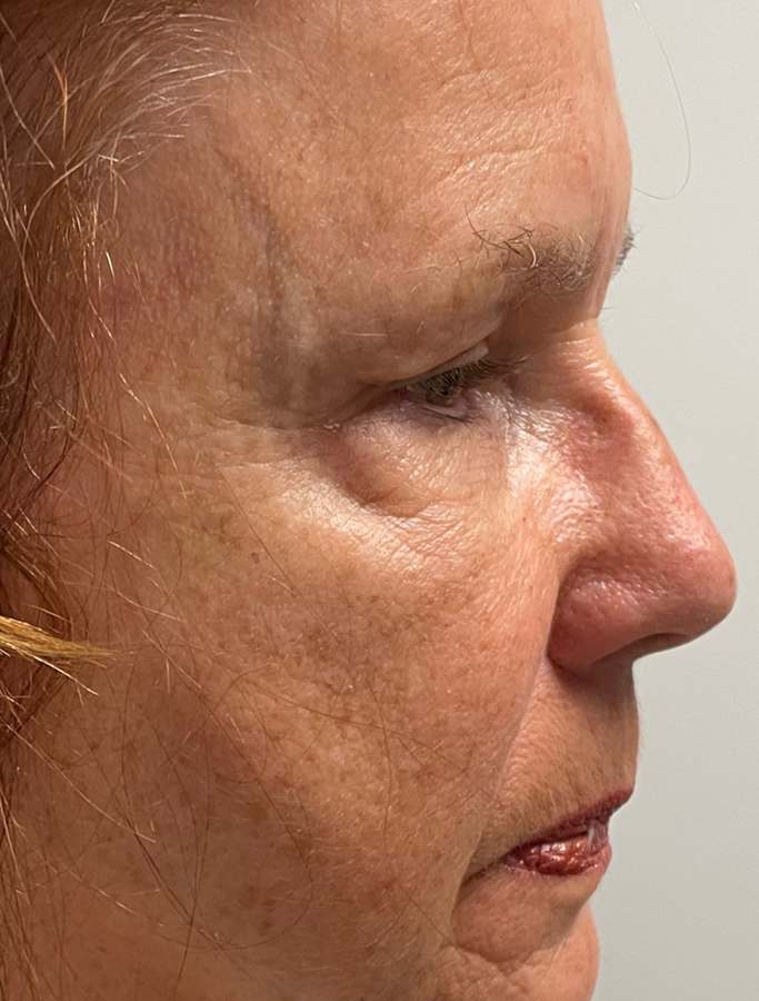 After Image: Patient Case #1949 - right-side