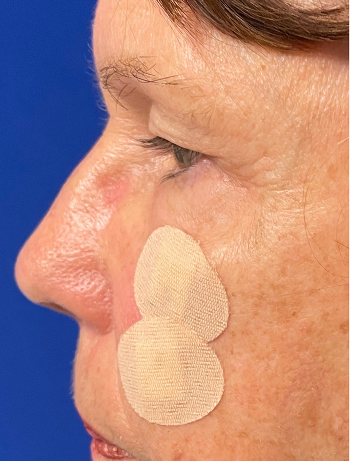 Before Image: Patient Case #1949 - left-side