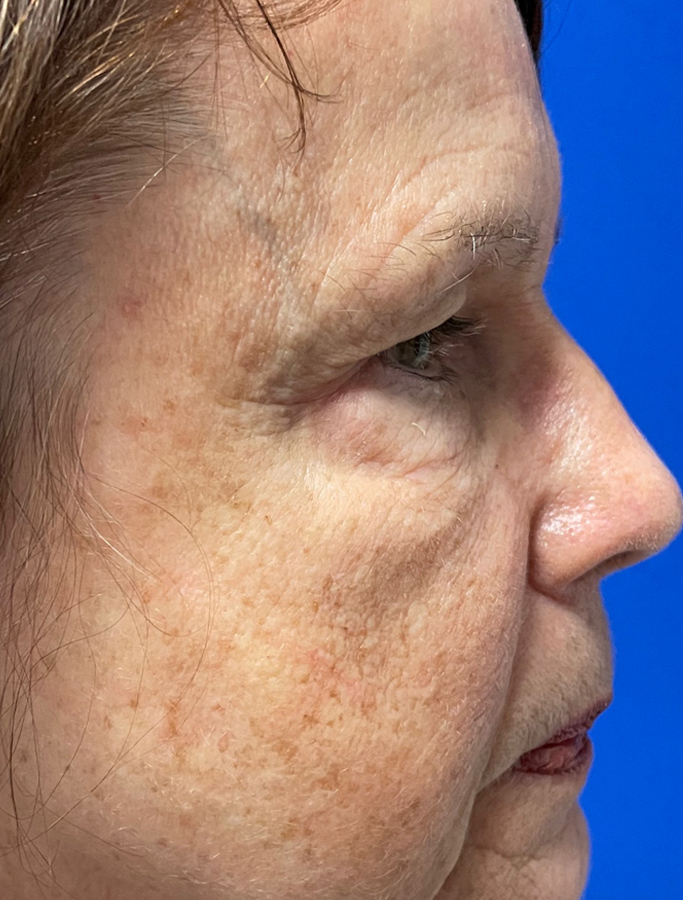 Before Image: Patient Case #1949 - right-side