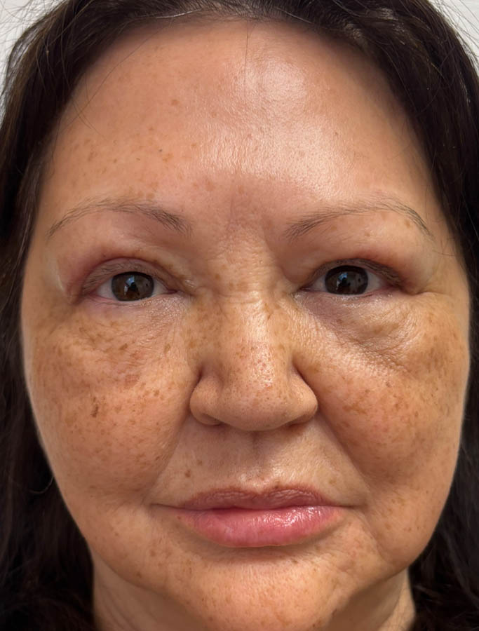 After Image: Patient Case #1621 - front