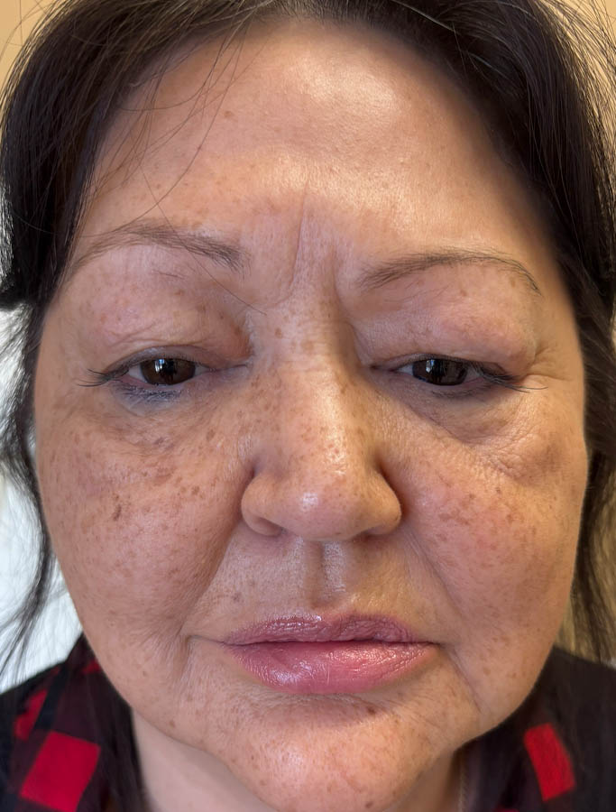 Before Image: Patient Case #1621 - front