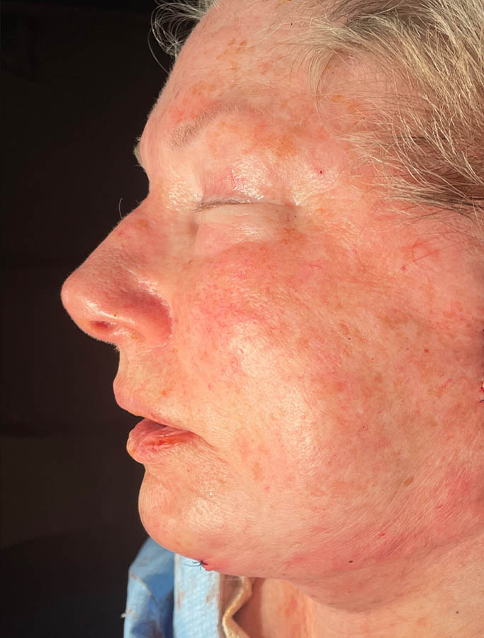 After Image: Patient Case #18086 - left-side