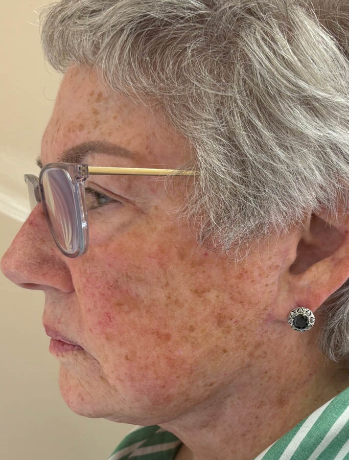 After Image: Patient Case #18099 - left-side