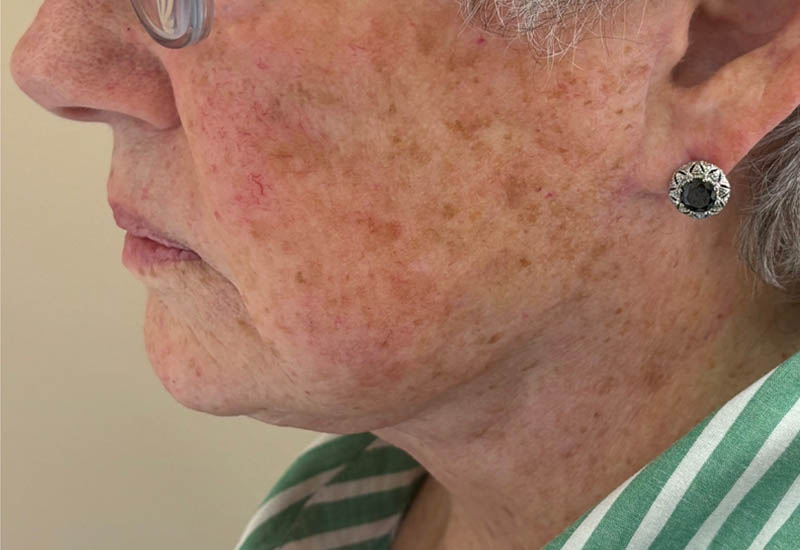 After Image: Patient Case #18099 - left-side