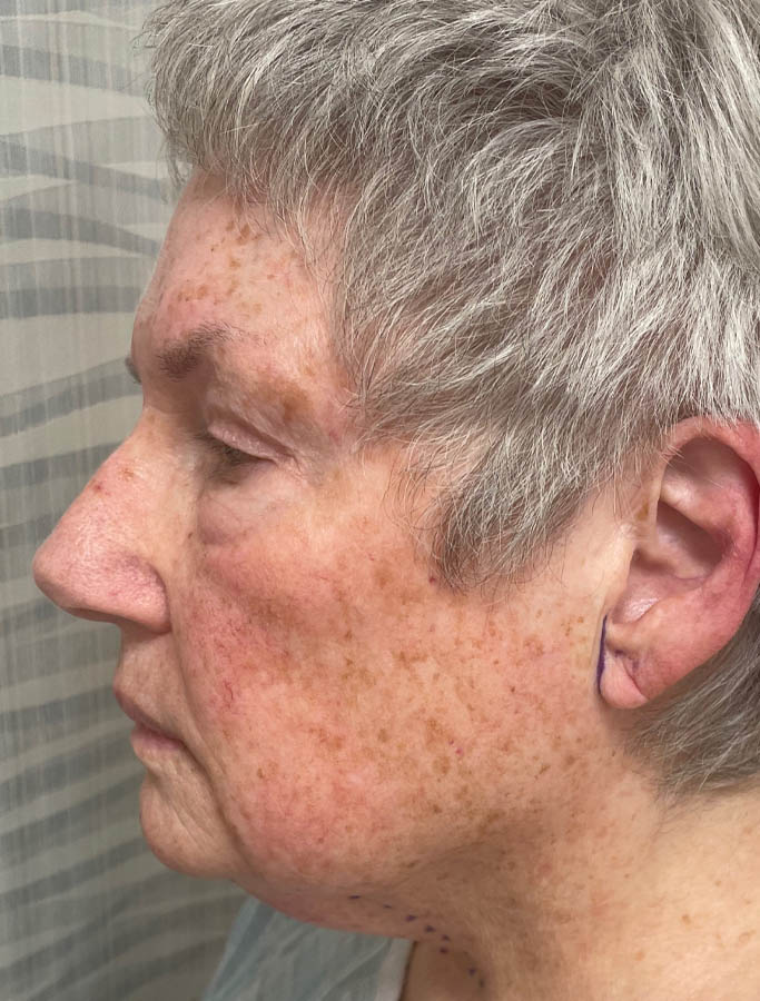 Before Image: Patient Case #18099 - left-side