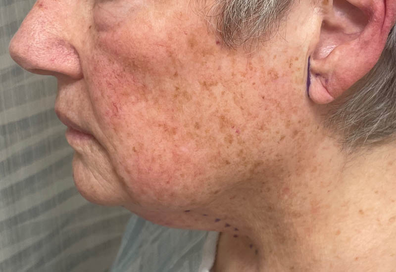 Before Image: Patient Case #18099 - left-side