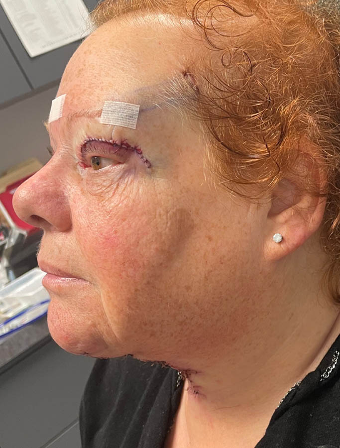 After Image: Patient Case #18104 - left-side