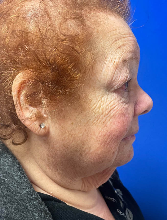 Before Image: Patient Case #18104 - right-side